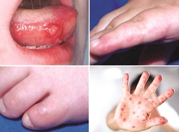 Cảnh báo bệnh tay chân miệng vào mùa - ảnh 1