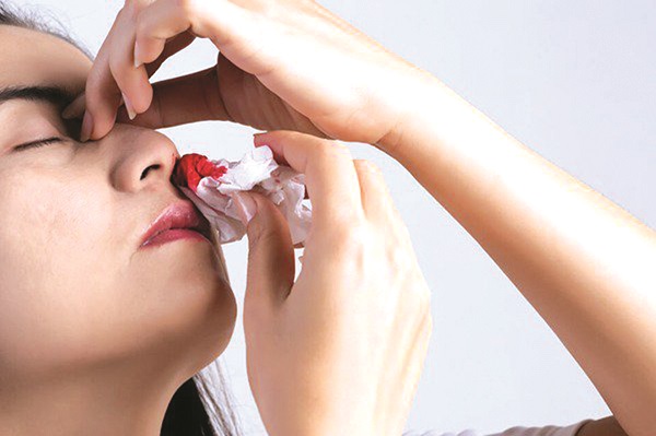 Chảy máu mũi và những điều cần biết - ảnh 1