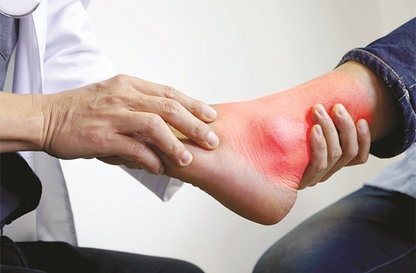 Những triệu chứng của bệnh gout và cách chữa trị - ảnh 1