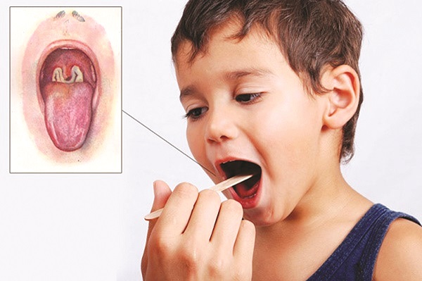 Bạch hầu: Nguyên nhân, triệu chứng và cách phòng ngừa - ảnh 1