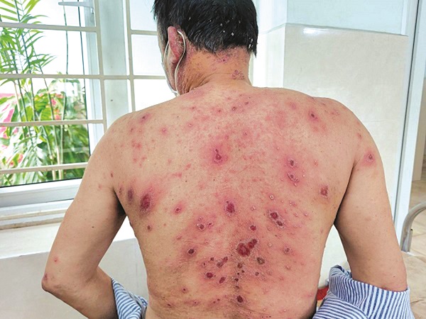 Cảnh giác nguy cơ dị ứng thuốc nặng sau điều trị bằng thuốc Nam - ảnh 1