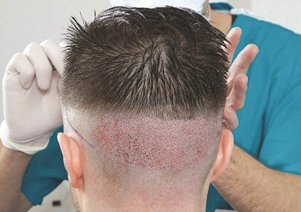 Cấy tóc tự thân, cần chú ý gì? - ảnh 1