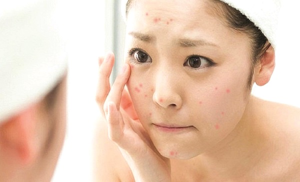 Các cách để “tiễn biệt” mụn cám - ảnh 1