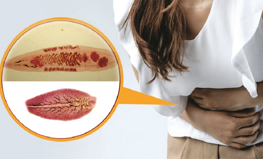 Nhiễm sán lá gan nặng vì thói quen ăn đồ tái, sống - ảnh 1