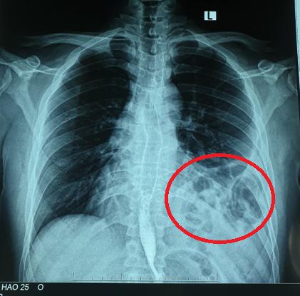 Ho, khó thở... tưởng do hậu Covid, hóa ra bị thoát vị tạng bụng lên ngực trái - ảnh 1