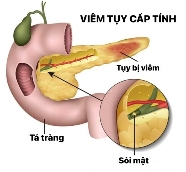 Bệnh lý tuyến tụy liên quan đến rượu và ăn uống - ảnh 1