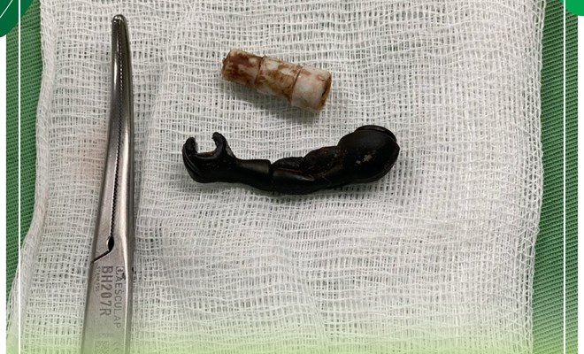 Lấy 2 dị vật trong vùng kín bé gái 5 tuổi - ảnh 1
