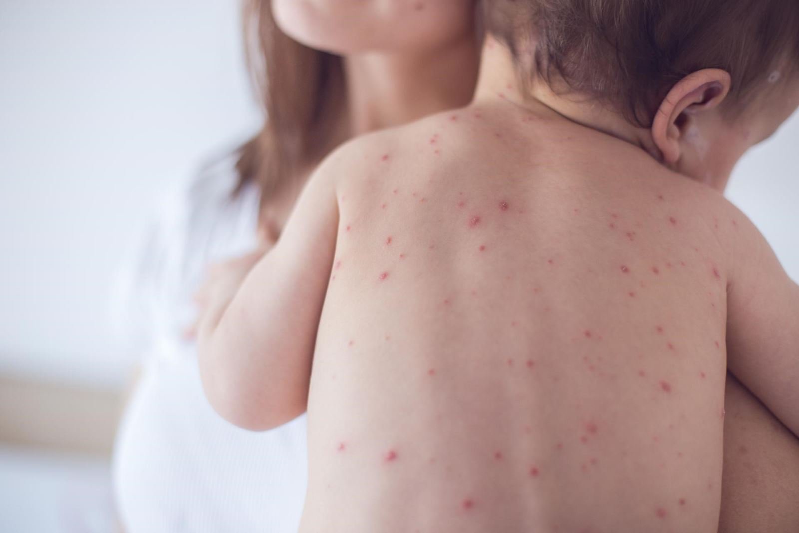 Cảnh báo gia tăng số trẻ em mắc thủy đậu tại Hà Nội - ảnh 1