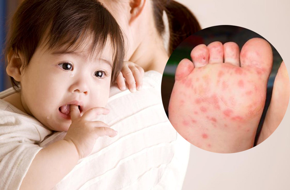 Tay chân miệng diễn biến bất thường, người dân chớ chủ quan - ảnh 1