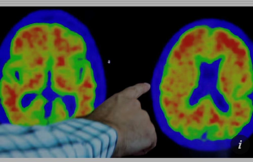Thuốc mới mang đến hi vọng chữa bệnh Alzheimer từ năm 2024 - ảnh 2