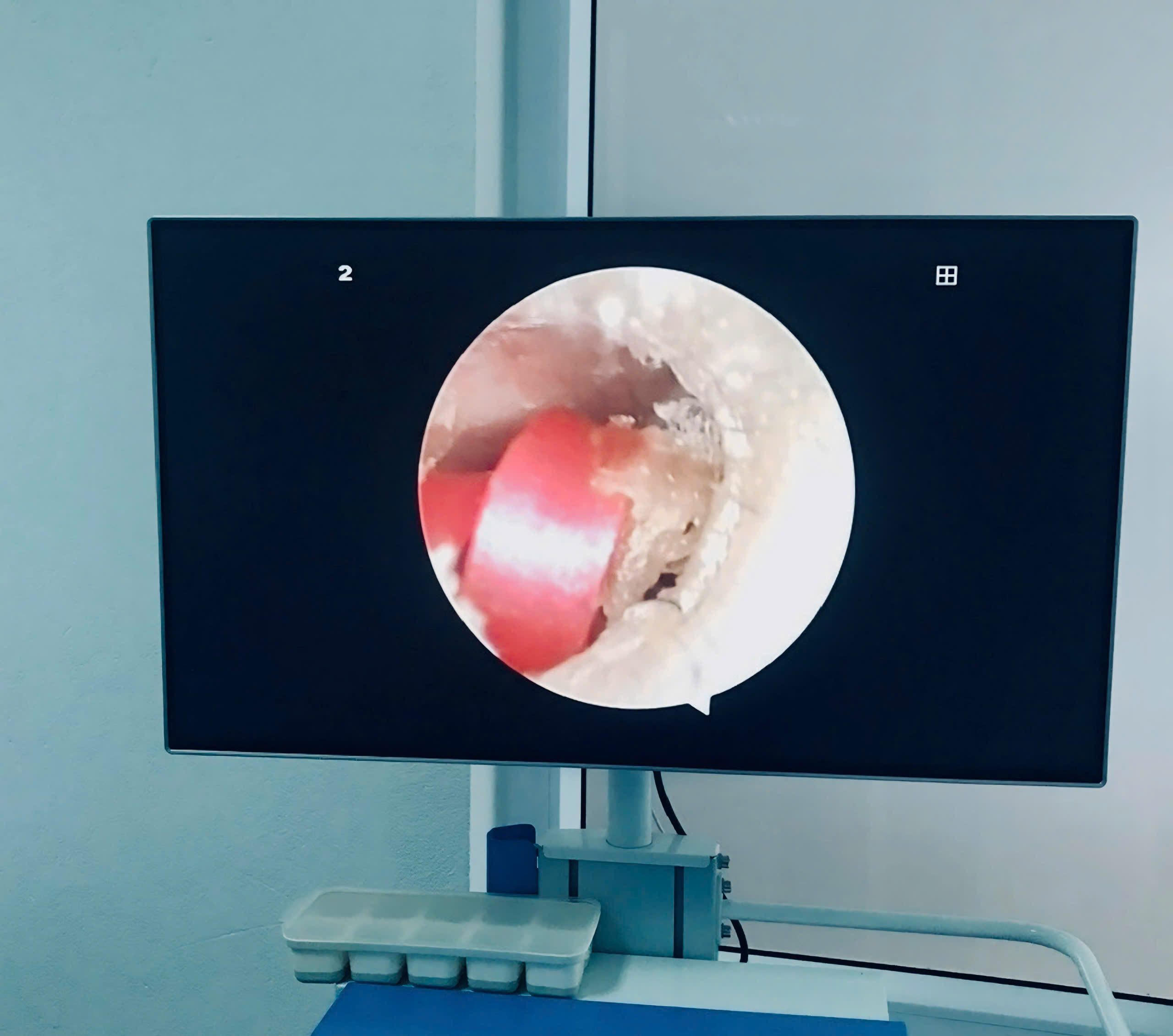 Suýt thủng màng nhĩ vì sợi dây buộc tóc - ảnh 1
