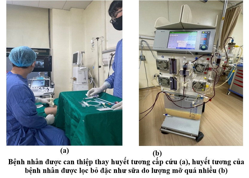 Cứu sống bệnh nhân viêm tuỵ cấp nặng nhờ thay huyết tương kịp thời - ảnh 1