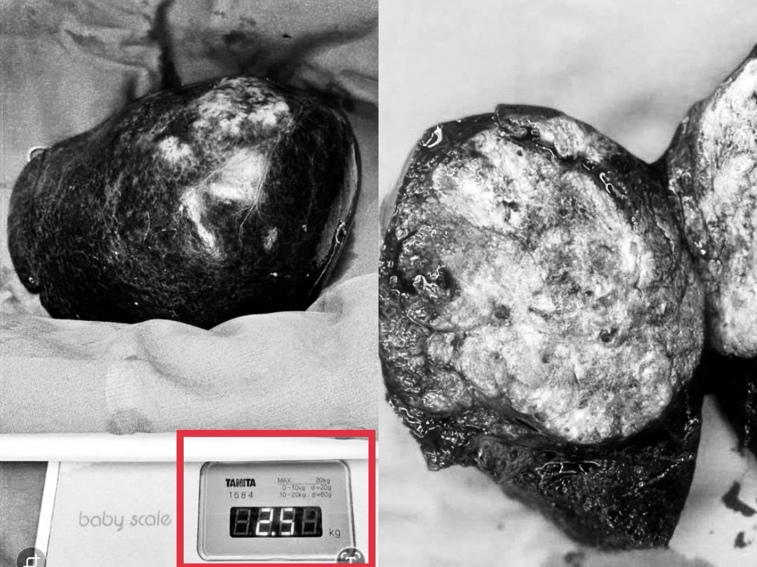 Cứu sống bệnh nhân ung thư gan muộn với khối u “khủng” 14cm - ảnh 1