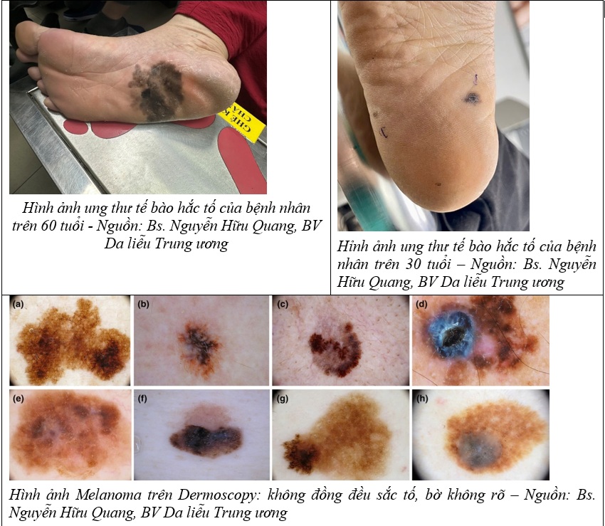 Ung thư da ác tính: Bác sĩ da liễu cảnh báo về dấu hiệu đốm đen trên bàn chân - ảnh 1