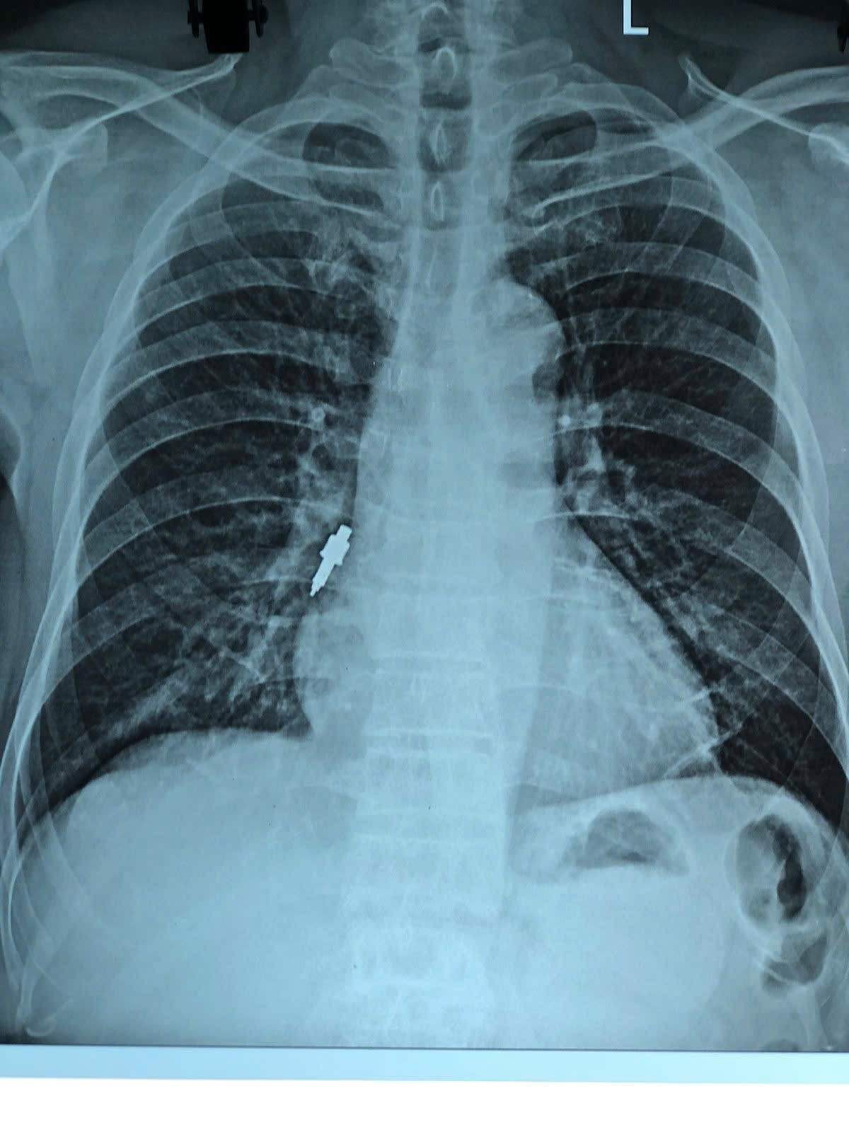 BV Hữu Nghị cấp cứu thành công ca dị vật phế quản nguy hiểm hiếm gặp - ảnh 1