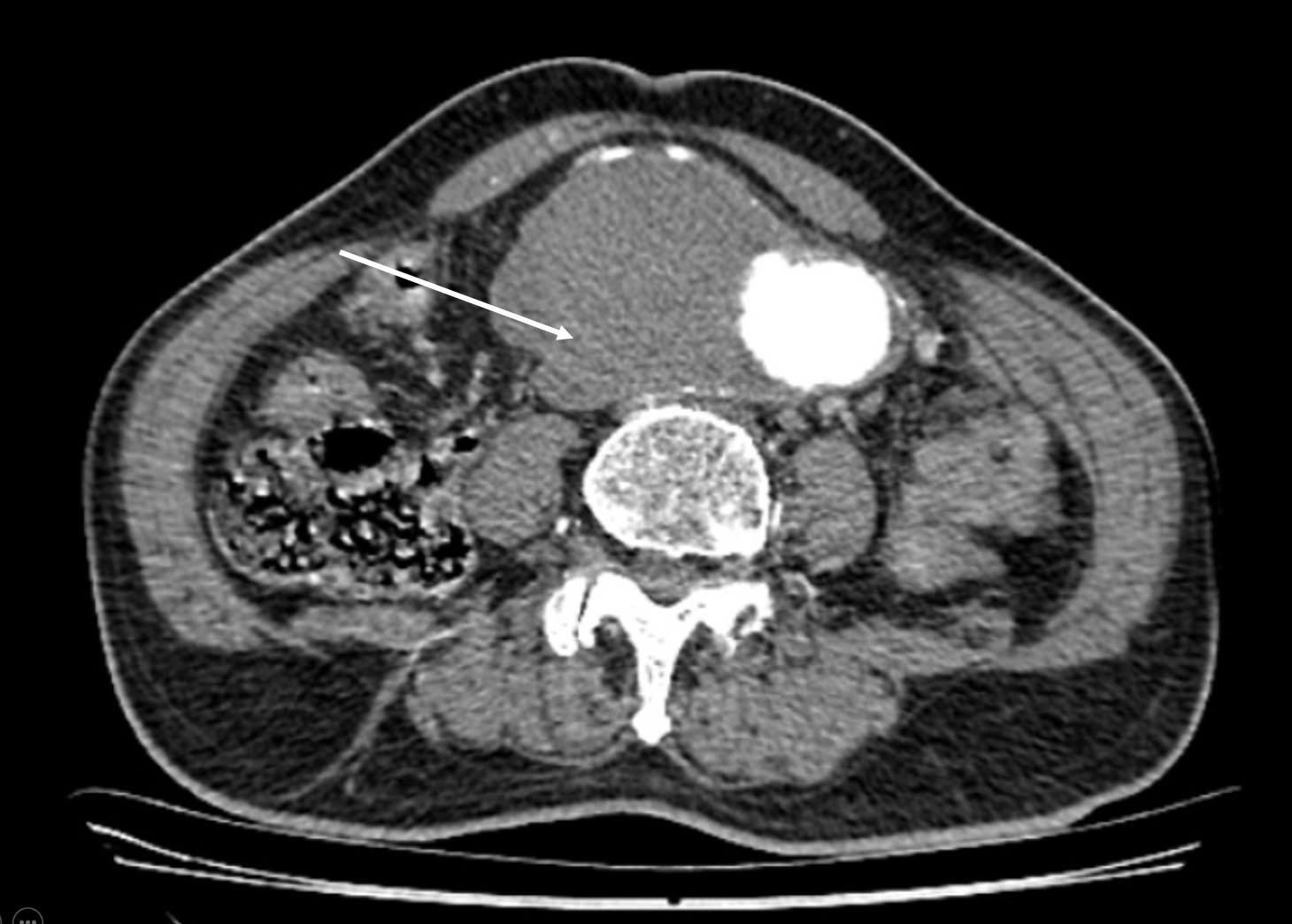 BV Hữu Nghị cứu sống người bệnh phình động mạch chủ và ung thư cùng lúc - ảnh 2