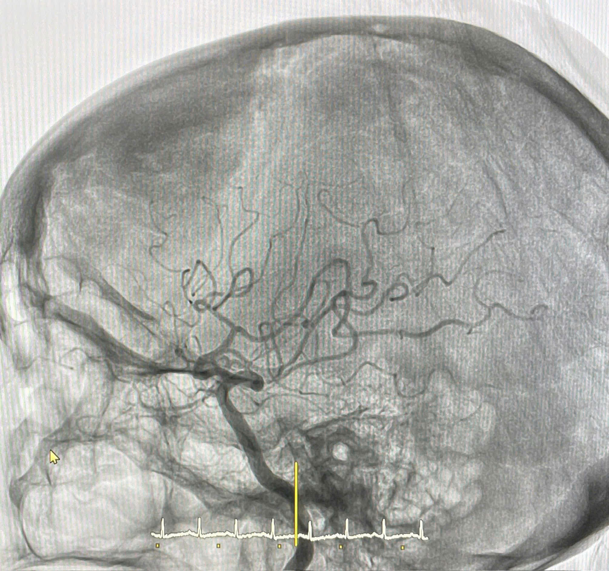 Cấp cứu thành công bệnh nhân đột quỵ não do tắc động mạch não giữa bằng kỹ thuật hút huyết khối - ảnh 1