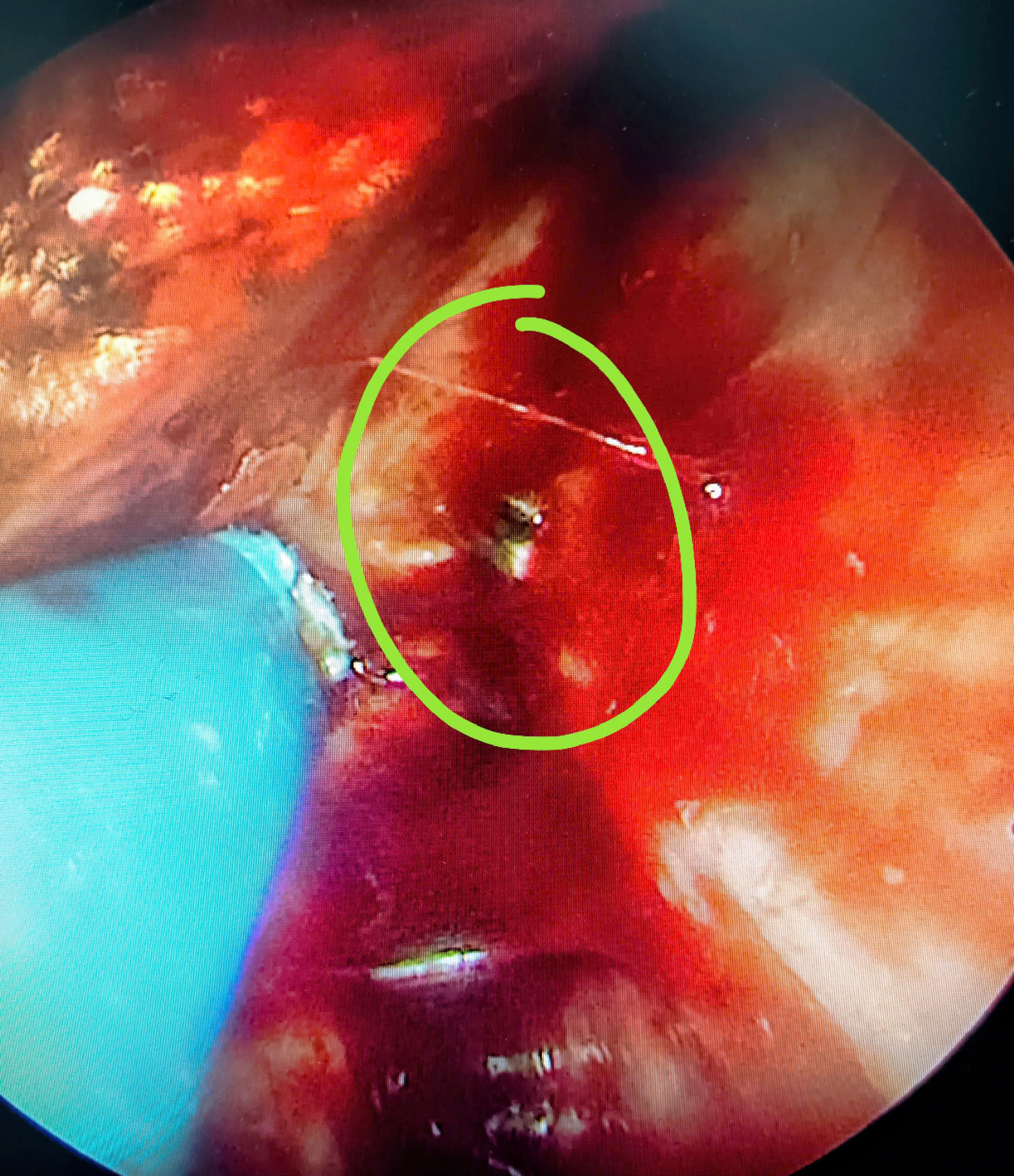 Bệnh viện Hữu nghị phẫu thuật thành công ca dị vật vách ngăn mũi tồn dư hơn 40 năm - ảnh 1