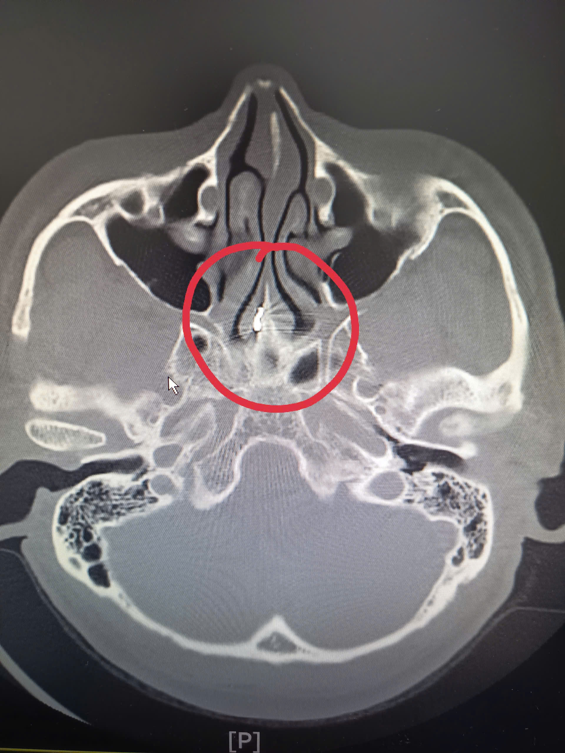Bệnh viện Hữu nghị phẫu thuật thành công ca dị vật vách ngăn mũi tồn dư hơn 40 năm - ảnh 2
