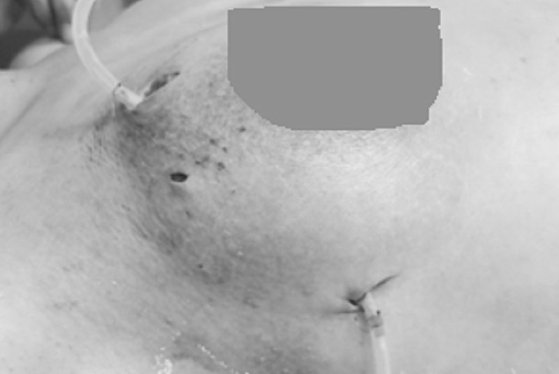 Suýt mất ngực vì tin lời quảng cáo “Nâng ngực không phẫu thuật“ - ảnh 1