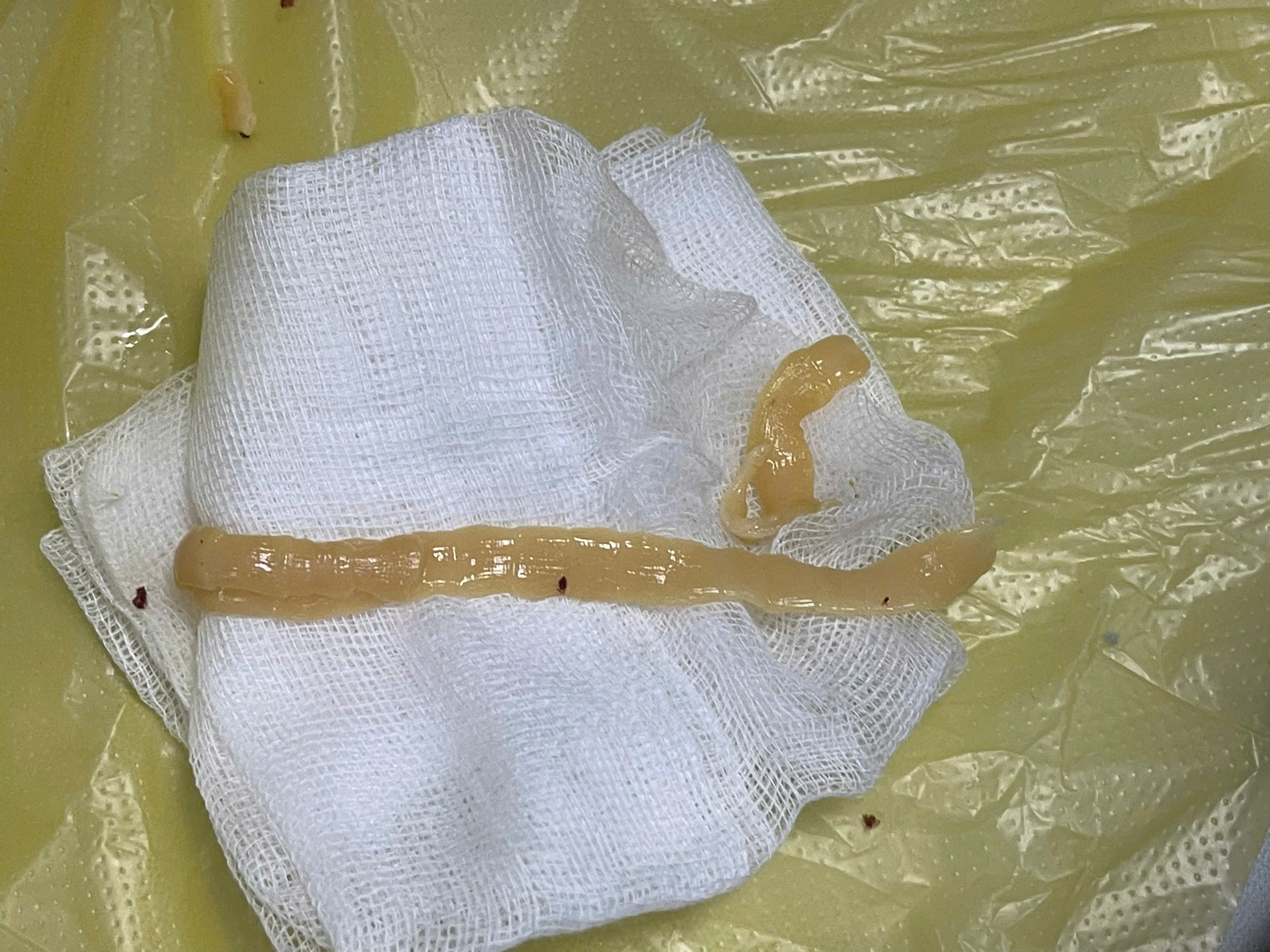 Thường xuyên ăn đồ tái, người đàn ông phát hiện nhiễm sán dây dài gần 80cm trong đại tràng - ảnh 2