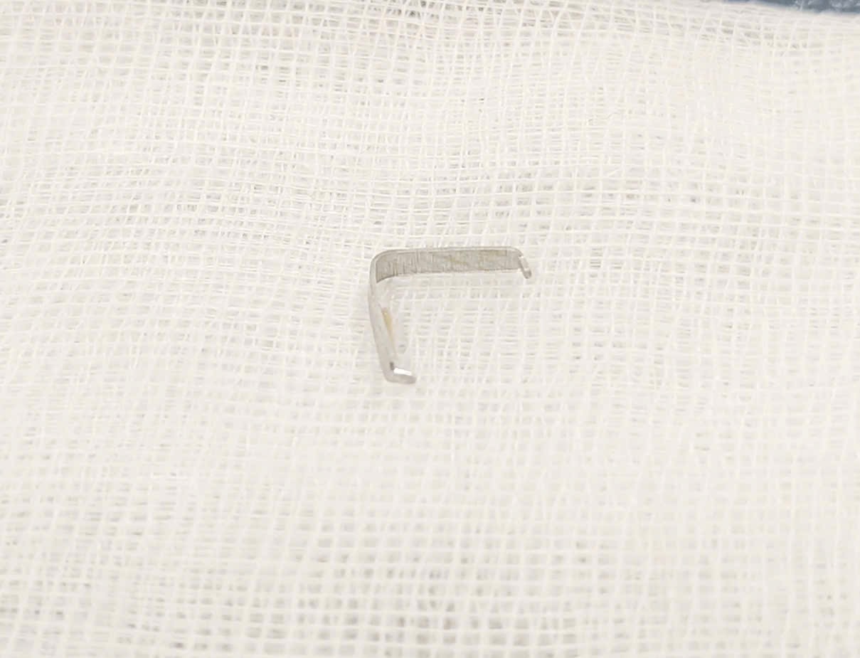 Tưởng trẻ kém ăn, hóa ra hóc ghim sắc nhọn trong họng - ảnh 2