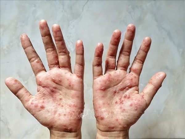 Hiểu rõ về những triệu chứng của bệnh đậu mùa khỉ - ảnh 1