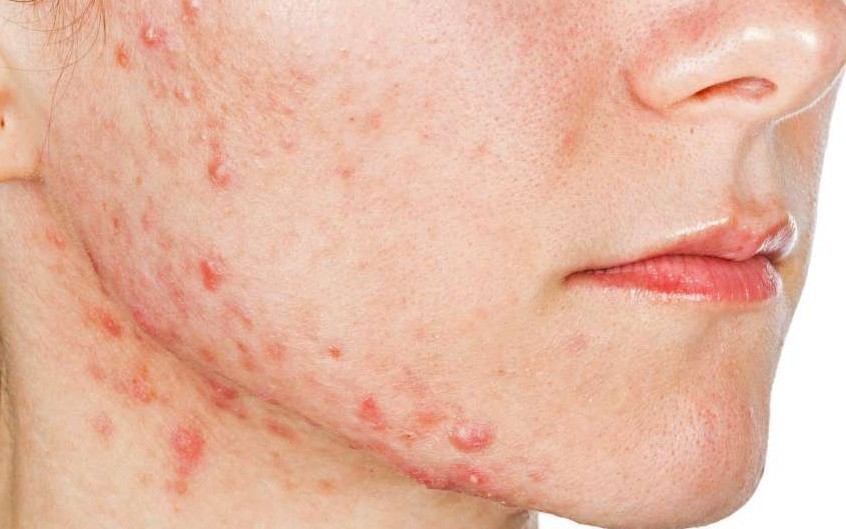 Bệnh trứng cá đỏ ở trẻ em - ảnh 1