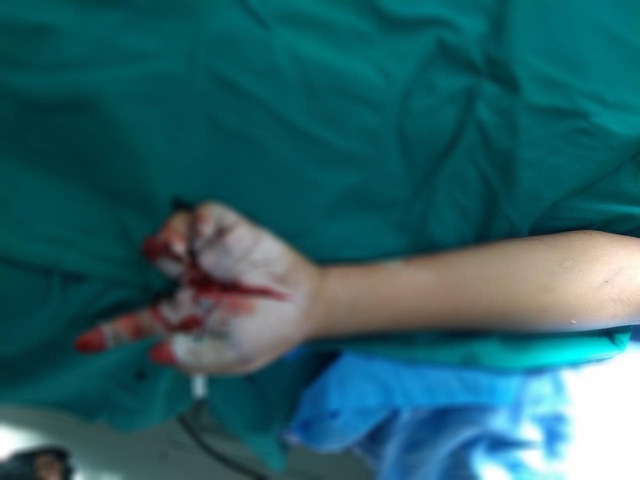 Bàn tay bị thương của bệnh nhi N