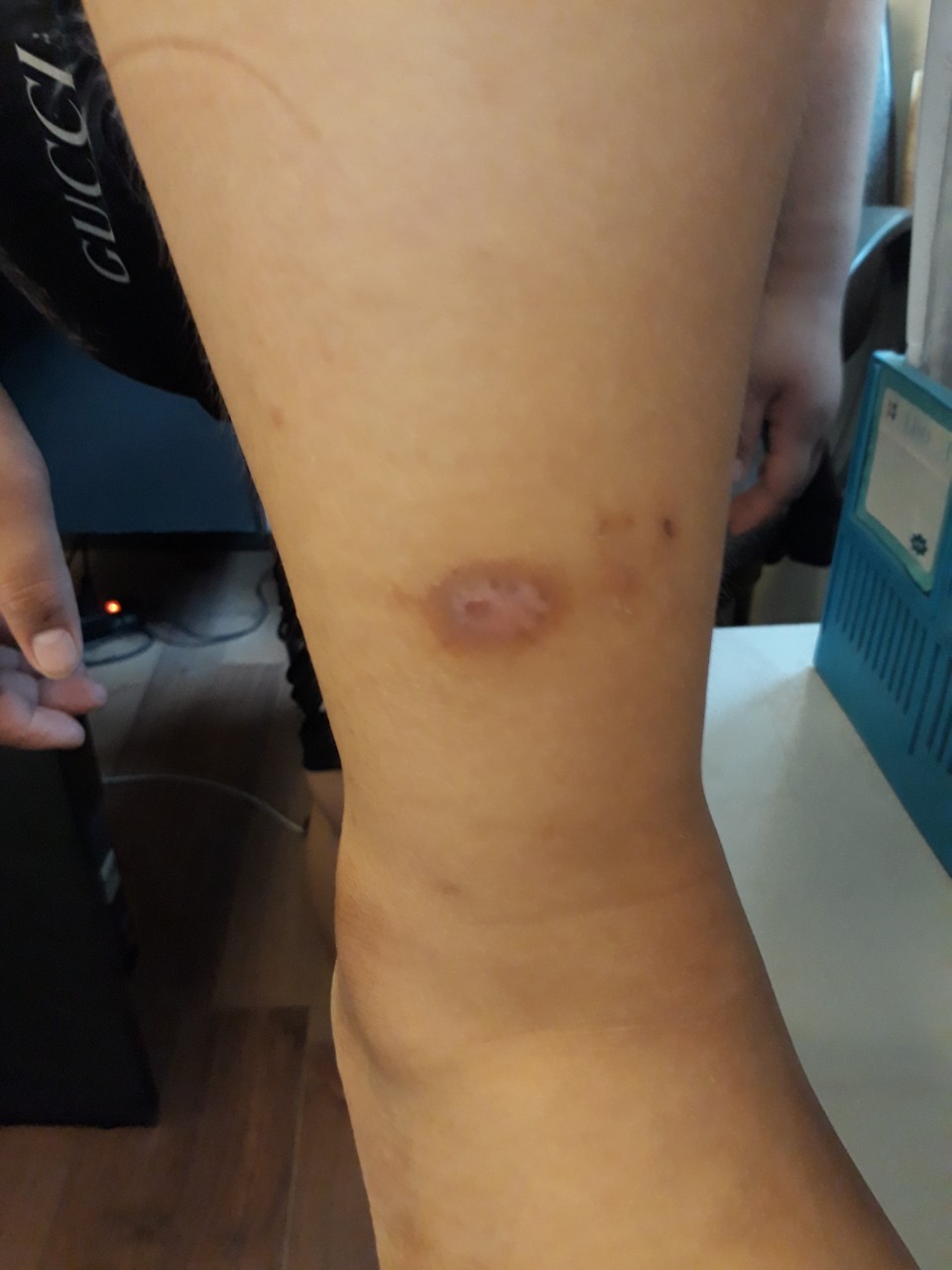 Những vết sẹo tr&ecirc;n th&acirc;n thể ch&aacute;u K được cho l&agrave; bị mẹ kế bạo h&agrave;nh