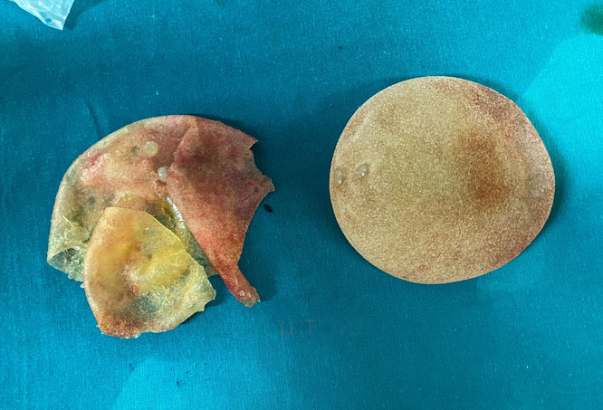 Túi ngực đã vỡ được lấy ra từ cơ thể bệnh nhân. Túi ngực đã vỡ được lấy ra từ cơ thể bệnh nhân.