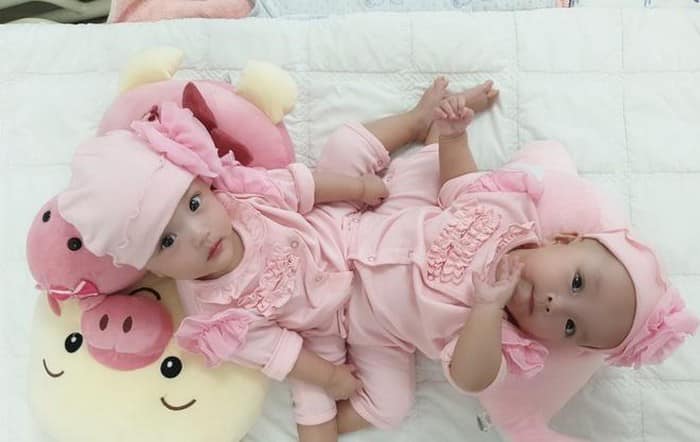 Cặp song sinh dính liền vùng bụng chậu.