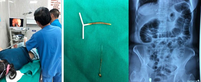 K&iacute;p b&aacute;c sĩ Khoa Nội soi ti&ecirc;u h&oacute;a thực hiện gắp dị vật cho bệnh nh&acirc;n N