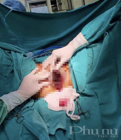 Bs Khoa Phẫu thuật tạo hình thẩm mỹ BV Xanh Pôn cấp cứu cho bệnh nhân.