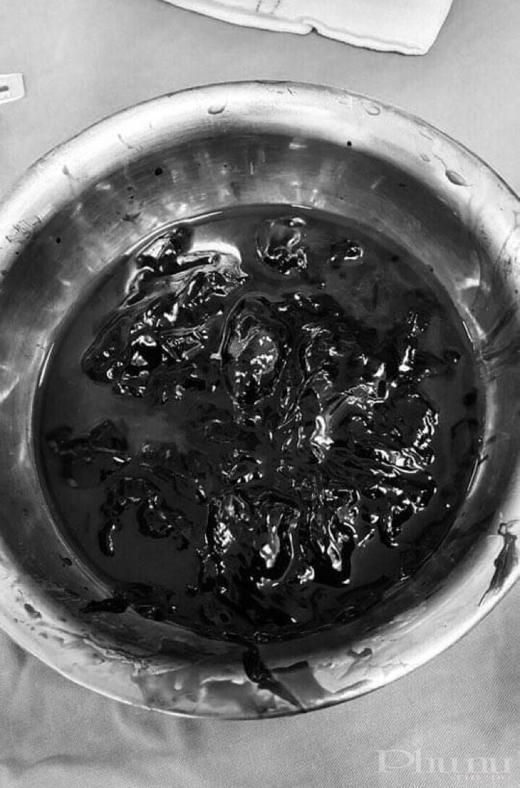 Lượng máu tụ được bác sĩ lấy ra từ khu vực thương tổn của nạn nhân.