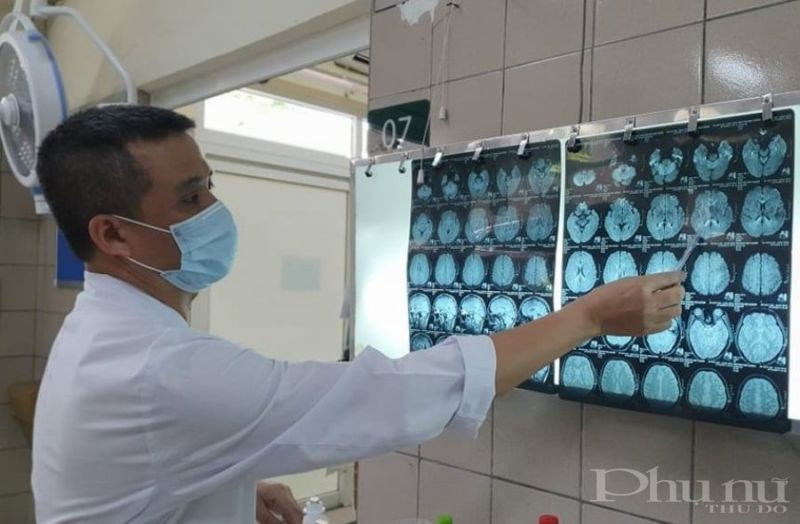 Hình ảnh phim cộng hưởng từ sọ não có tổn thương chất trắng lan tỏa trên não.