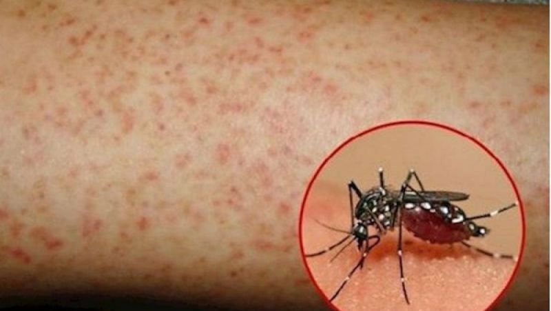 Sốt xuất huyết và Covid-19 đều là các bệnh truyền nhiễm nguy hiểm gây dịch do virus gây ra, tuy nhiên đây là hai bệnh có yếu tố dịch tễ và đường lây truyền cũng như bệnh cảnh hoàn toàn khác nhau.