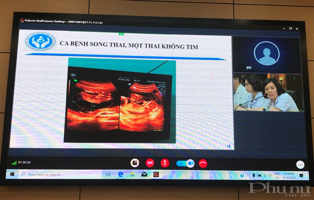 Bác sĩ bệnh viện Phụ sản Hà Nội tư vấn trường hợp ca bệnh không tim cho bệnh viện tuyến dưới.