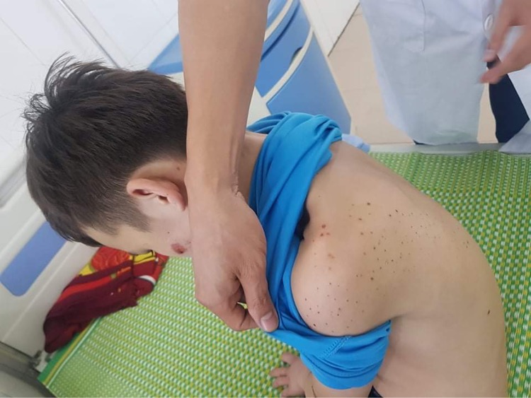 Cháu D bị thương tích khắp cơ thể Cháu D bị thương tích khắp cơ thể