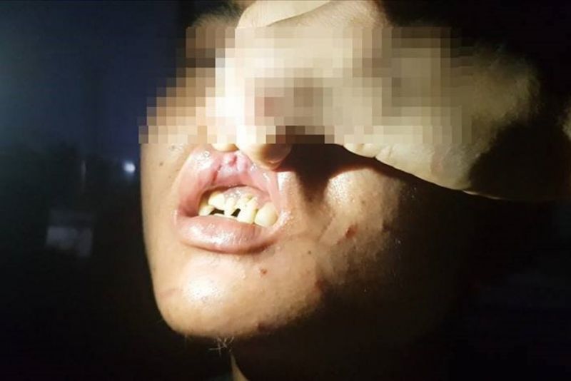 Đ kể, em bị đánh đập tra tấn tàn nhẫn, vết thương ở hàm trên còn mới, răng bị gẫy nhiều Đ kể, em bị đánh đập tra tấn tàn nhẫn, vết thương ở hàm trên còn mới, răng bị gẫy nhiều