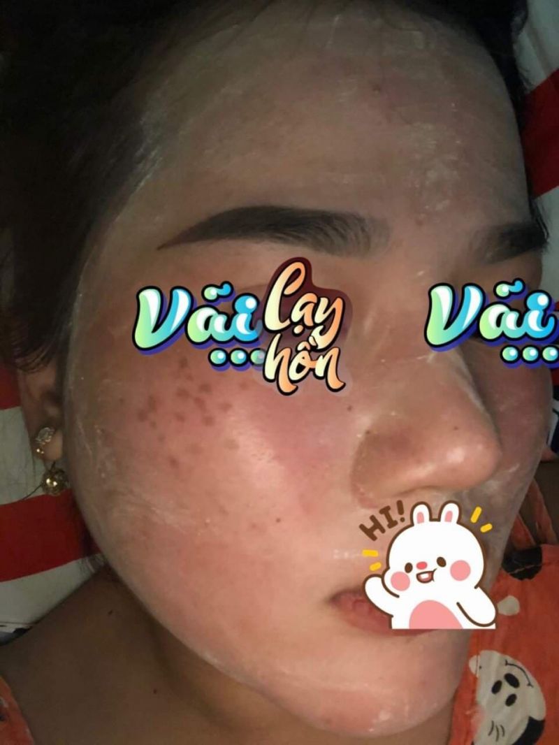 T&igrave;nh trạng l&agrave;n da bị ph&aacute; hủy do mỹ phẩm k&eacute;m chất lượng