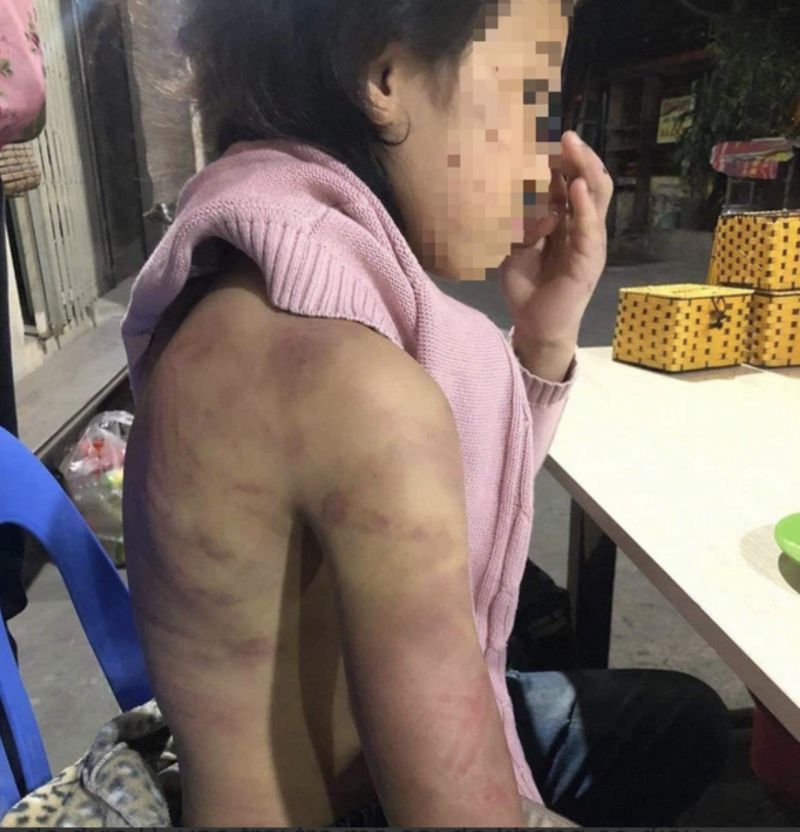 Hình ảnh cháu B nghi bị mẹ đánh đập và người tình của bố xâm hại Hình ảnh cháu B nghi bị mẹ đánh đập và người tình của bố xâm hại