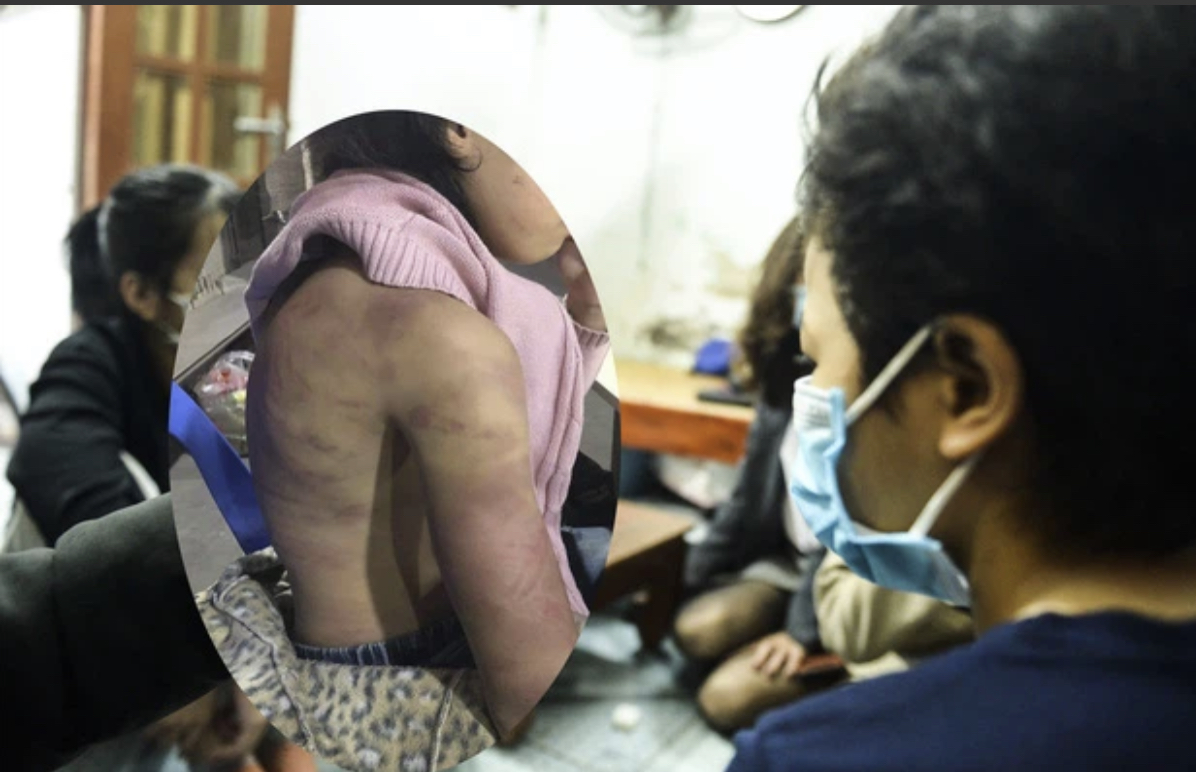 Những vết thương tr&ecirc;n cơ thể ch&aacute;u b&eacute; bị mẹ đẻ đ&aacute;nh đập