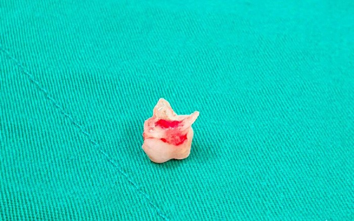 Dị vật là chiếc răng được bác sĩ lấy ra - Ảnh: BVCC