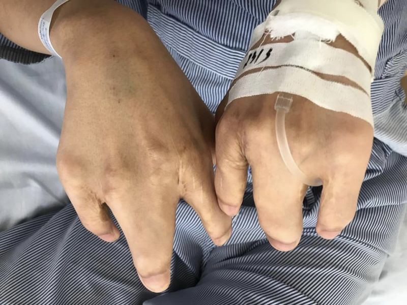 Dị tật dính đầu chi của bệnh nhân.