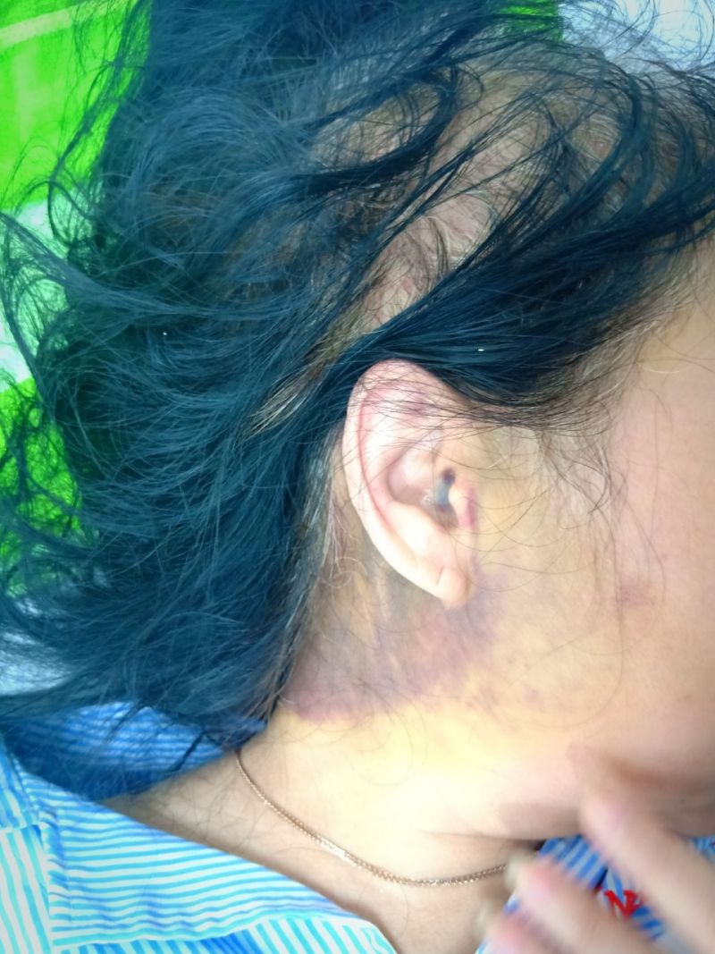 Bà Dung bị bầm tím