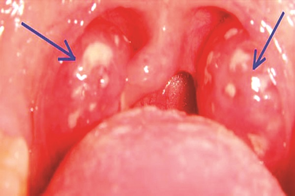 Những điều cần biết về viêm Amidan ở trẻ em - ảnh 1