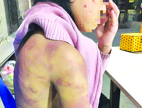 Hình ảnh cơ thể cháu bé B bị mẹ bạo hành Hình ảnh cơ thể cháu bé B bị mẹ bạo hành