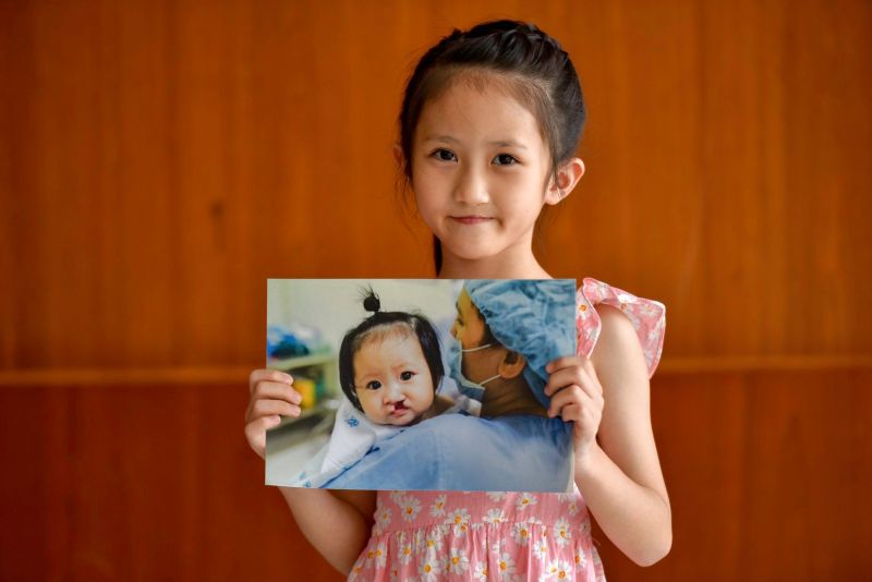 Khởi động chiến dịch vì cộng đồng phẫu thuật hở môi, hở hàm ếch và dị tật hàm mặt cho trẻ em Việt Nam - ảnh 2