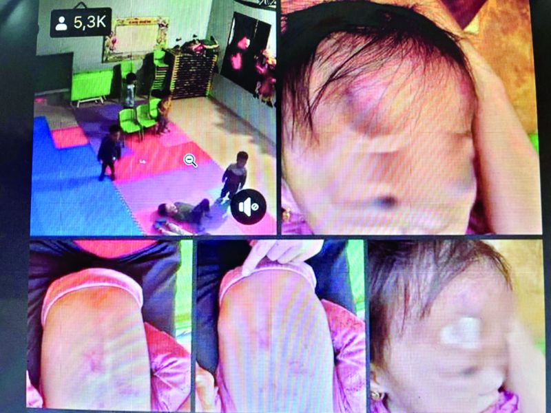 B&eacute; g&aacute;i 2 tuổi bị bạn đ&aacute;nh bầm t&iacute;m người tại trường mầm non